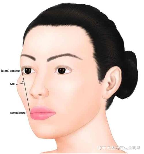 1,颧弓向两侧突出,中面部宽显脸大 2,颧骨向侧