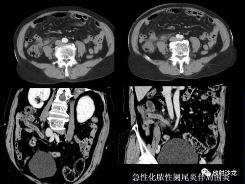 开课了 | 急性阑尾炎的ct诊断及鉴别诊断