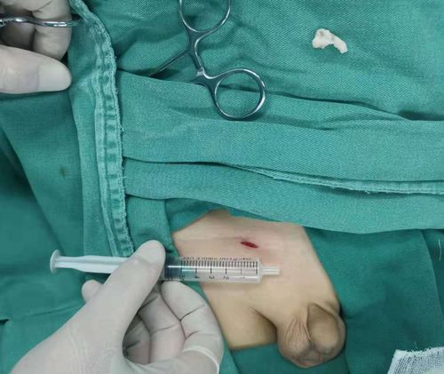 若长时间肠管不能回纳则有可能出现肠管缺血坏死等严重并发症