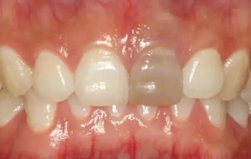 牙震荡是什么鬼,看完本文你便知