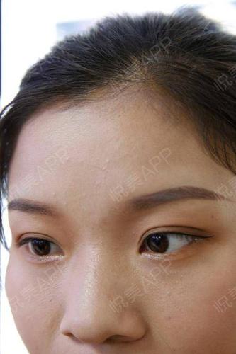 今天继续来给大家汇报一下我额头上的凹陷疤痕的恢复.