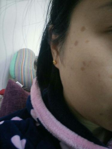 脸上起的圆形斑点是什么?怎样去除?