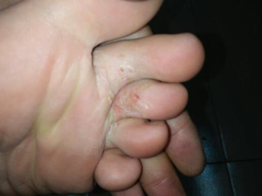 我的脚丫掉皮还痒,是怎么了,该怎么办