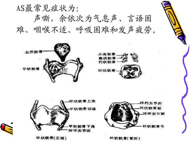 环杓关节半脱位.ppt