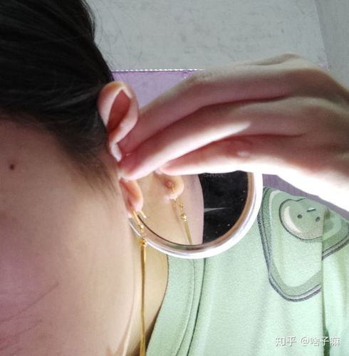 打了三个月耳洞,耳洞旁边长了一个像是血包的东西.