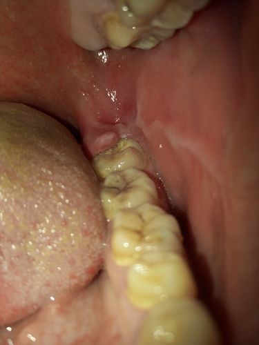 智齿牙后面长了一小块肉,这是怎么回事啊?