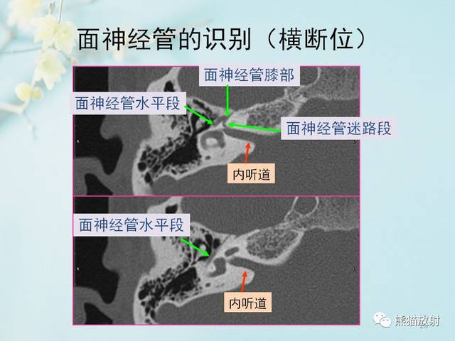 菜单栏内"各大系统"→"柳澄讲坛"面神经管鼓室段:起自面神经膝神经节