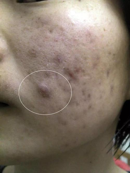 没有脓液的硬痘痘,有办法吗?