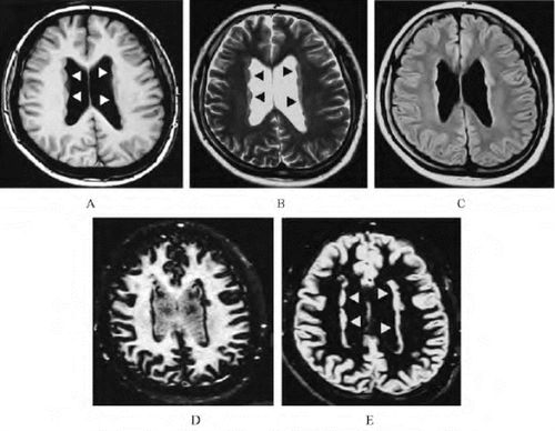 脑灰质异位_人体磁共振成像解