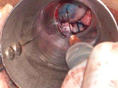 陈旧性肛裂混合痔肛乳头瘤手术步骤