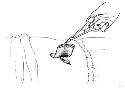 伤口换药法基本护理技术操