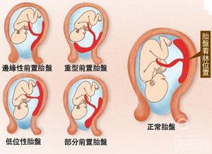 美国试管婴儿孕妇知识问答:女性孕期运动要注意胎盘低