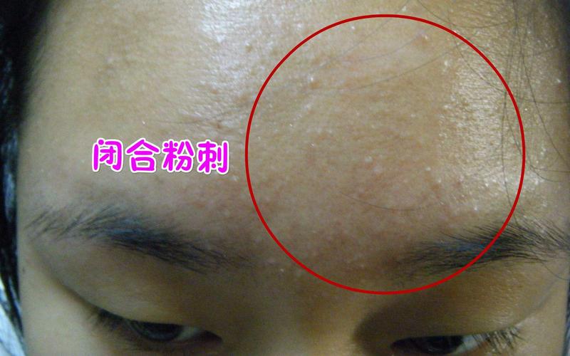听说有种皮肤问题叫逆光疹