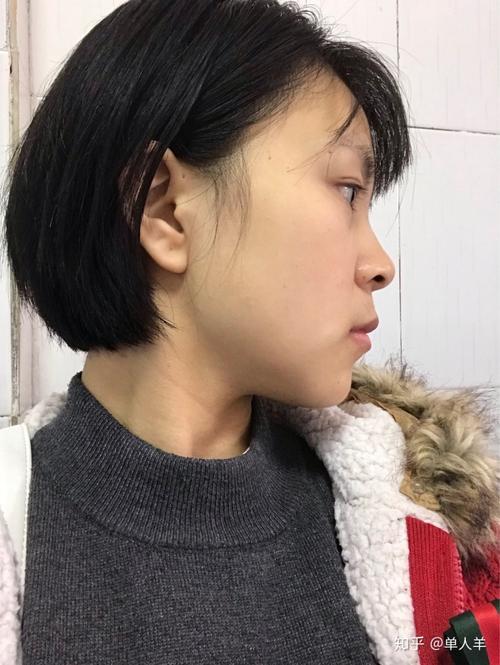 牙齿整齐但是上嘴凸,是否正畸效果不大?