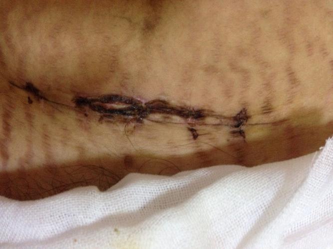 剖腹产伤口结痂中间有白白的是发炎了吗?有有经验的吗