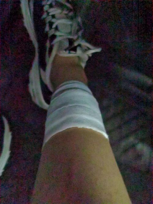 腿受伤了,只能练肩,真是摔出新高度,缝了五针,上一次缝针还是三岁的