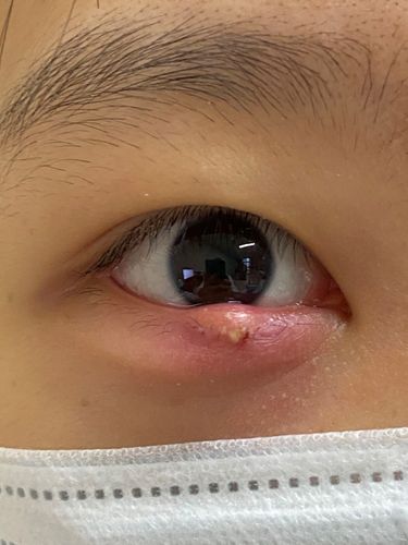 认识睑板腺疾病(上)_麦粒肿 - 好大夫在线