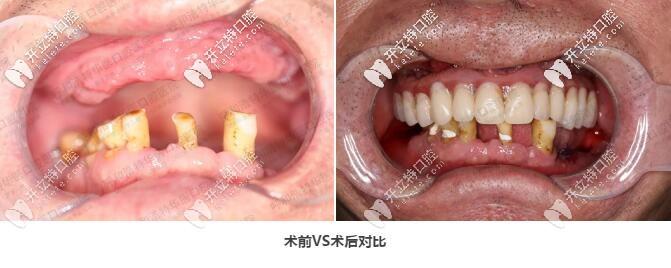 这是67岁老人做上半口allon6种植牙图片,即刻戴牙冠就能吃饭