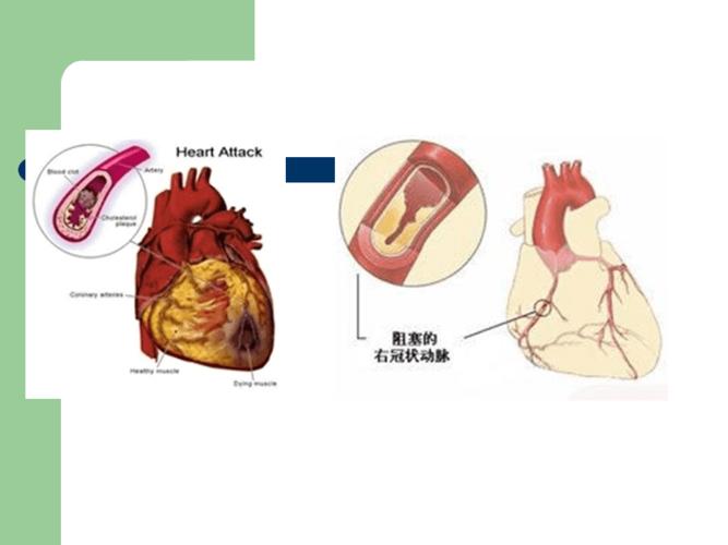 急性冠脉综合征