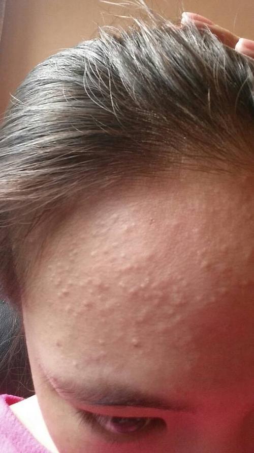 额头上长了好多小疙瘩不像痘痘是小小的颗粒虽说不痛不痒的但实在有碍