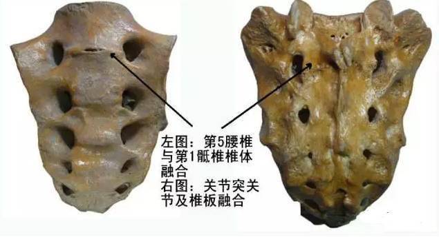 骶骨—常见的解剖变异(图文并茂)