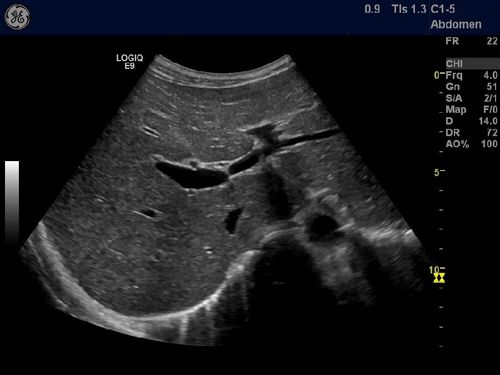 肝内实性结节,高回声,占位,血管瘤,小结节 剑突下斜切,第一肝门,正常