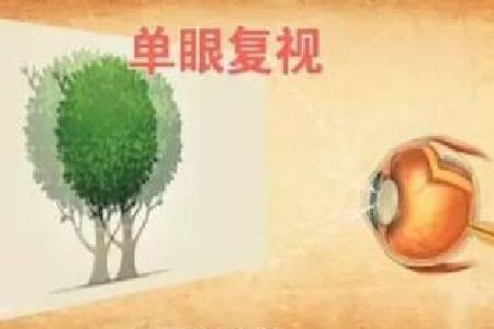 首大熊瑛:复视常见的治疗方法有哪几种