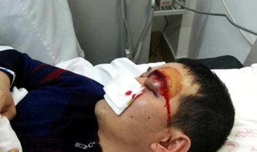 眼球挫伤可直接或间接是虹膜睫状体