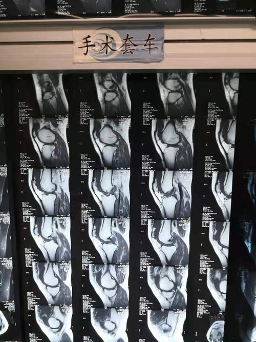 微创膝关节穿刺抽液清理术治疗痛风性关节炎合并关节积液