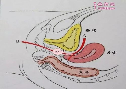 什么是"石女"?先天"无音道"是咋回事?和正常女心有何区别?
