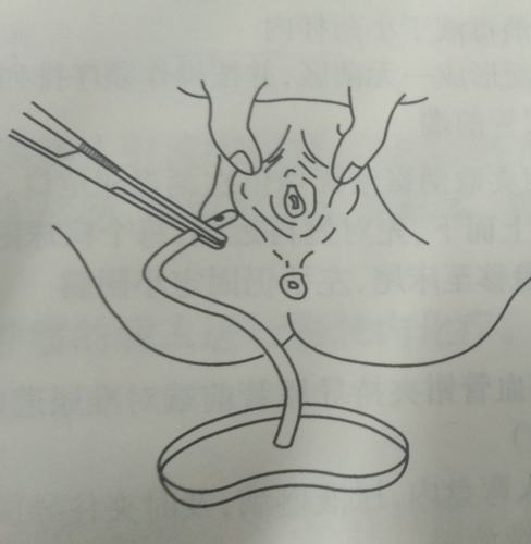 用镊子(或血管钳)尿管轻轻插入尿道4-6cm,见尿后再插入1-2cm