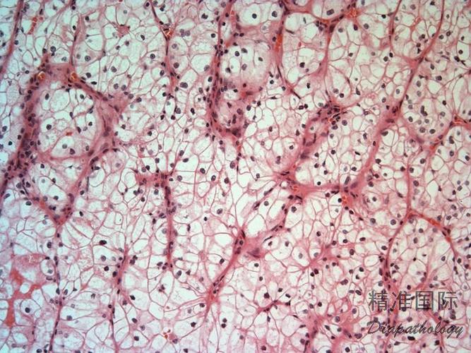 透明细胞肾细胞癌