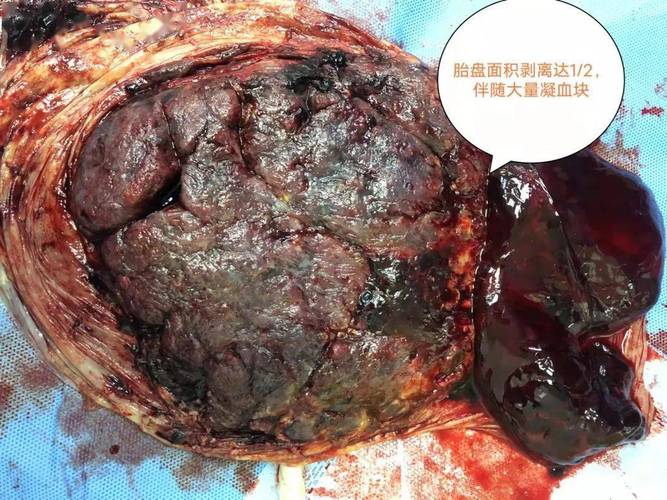 正常妊娠期胎盘附着于子宫后壁上,妊娠20周或分娩期,正常位置的胎盘于