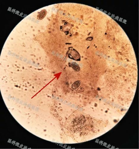 显微镜下疥虫卵全貌图 疥疮的治疗         治疗的目的是杀虫