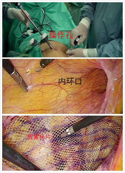腹腔镜微创疝修补手术