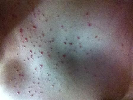 皮肤起艾滋病小红疙瘩风险多大图片