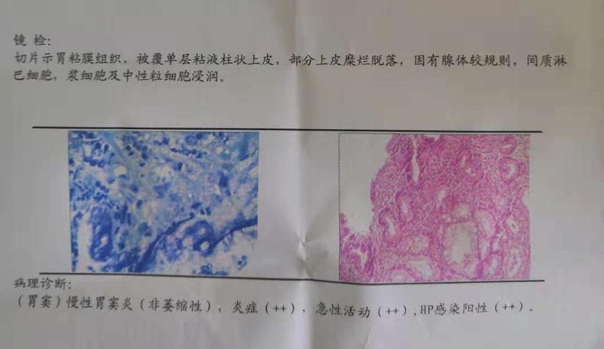 麻烦帮忙看一下胃镜 切片病理报告