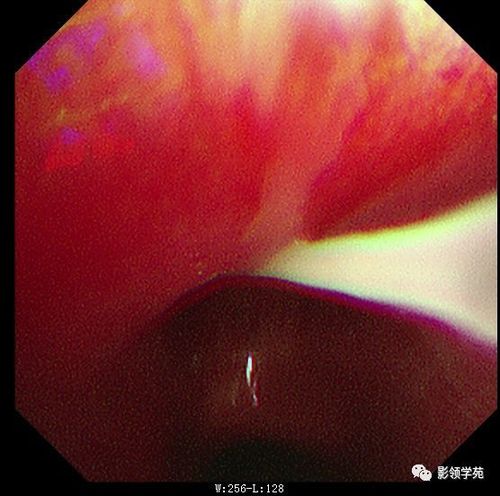 咳痰,为黄色粘痰伴痰中带血——淋巴细胞性间质性肺炎