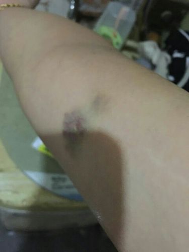 有人说是白血病,好可怕啊.谁知道说告诉我下.谢谢