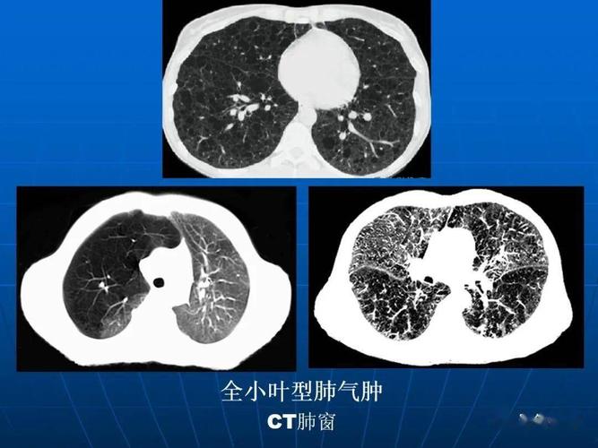 肺气肿的影像诊断