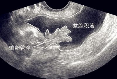 女性盆腔积液如何治疗?