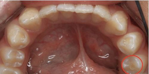 有些细心的妈妈会发现孩子新长的牙齿上有个异常凸起的小尖尖,这就是