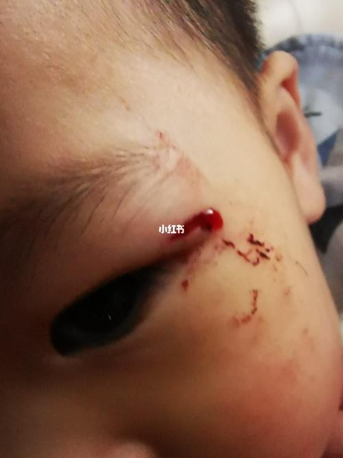 面部伤口小,可以用医用胶水粘伤口_母婴_育儿_母婴