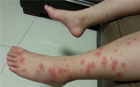 过敏性紫癜是儿童常