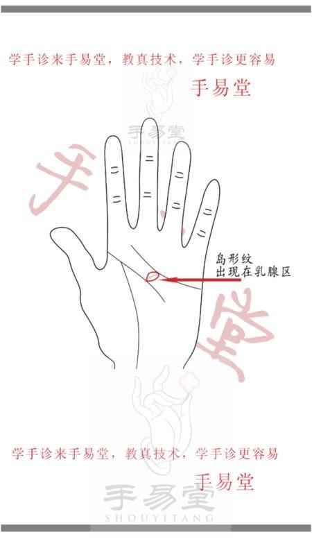 乳腺增生小叶增生