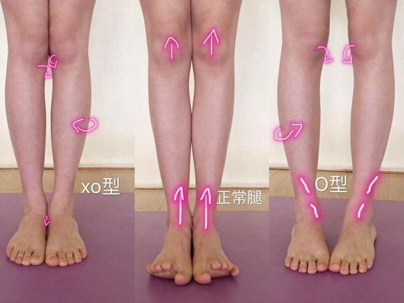 腿不直是正常的吗?