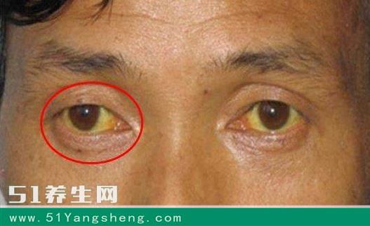 眼睛出现这些症状千万别忽视可能是大病征兆