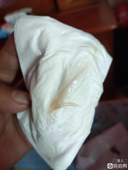 孕晚期白带有血丝是快生了吗?