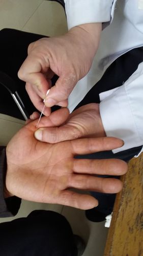 小针刀治疗狭窄性腱鞘炎