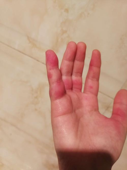 手上这几天长红斑了,又痛又痒的,泡热水还挺痛,有人知道咋回事吗